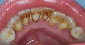 plaque-teeth